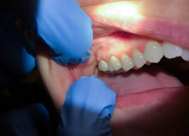 Best Dentist for Tooth Abscess  in Vandercook Lake, MI